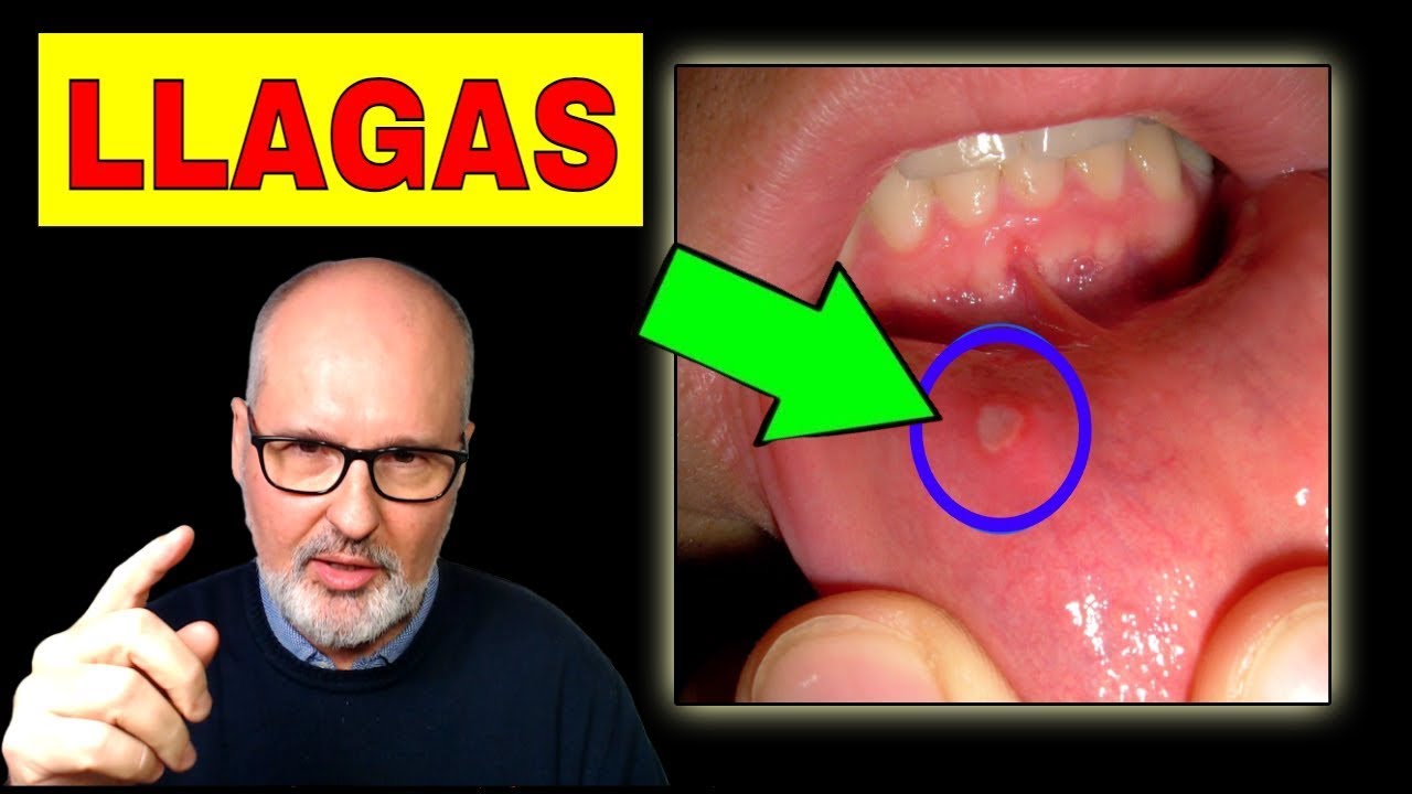 la sal cura heridas en la boca