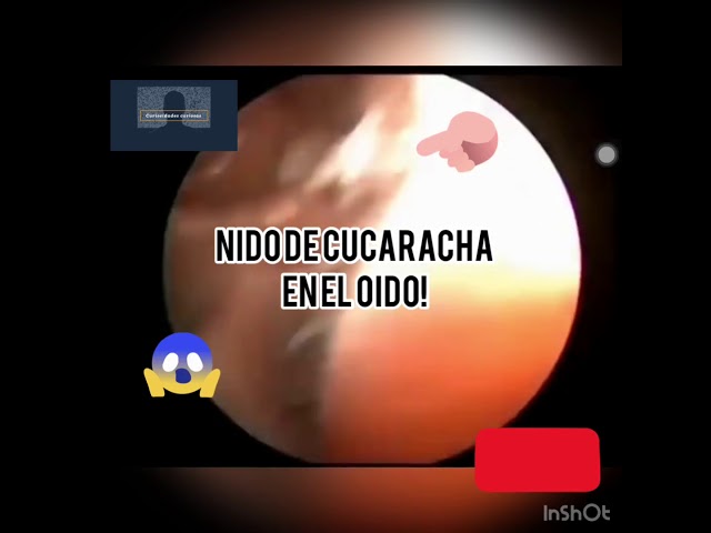 nido de cucarachas en el oido